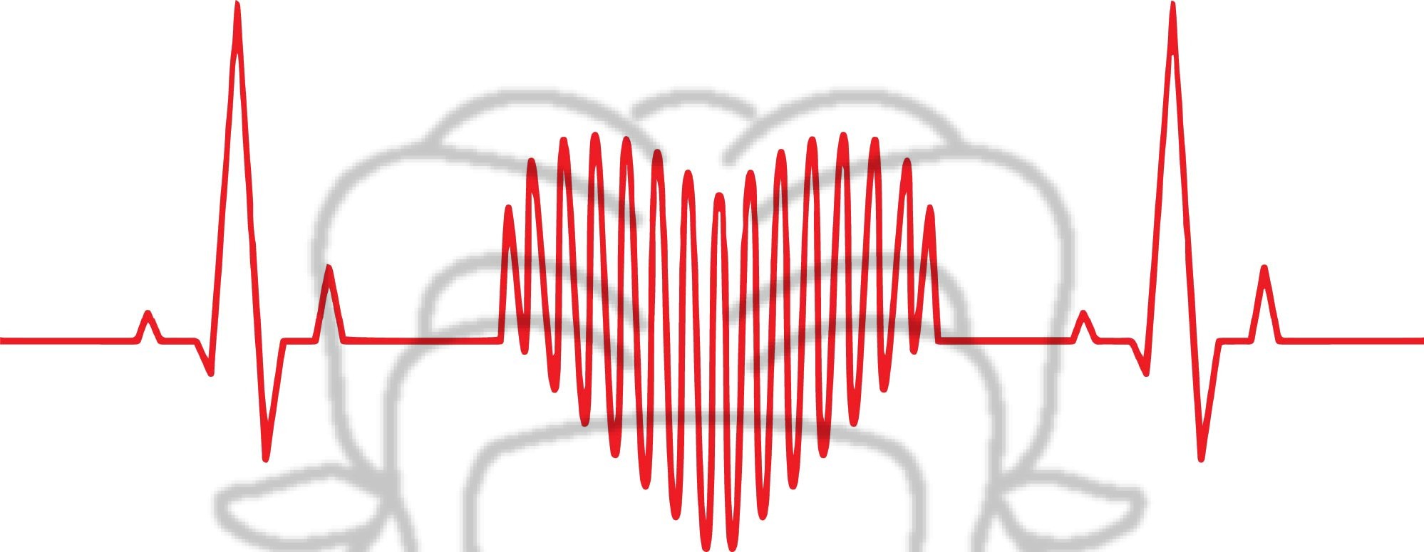 EKG
